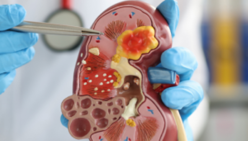 Disfunción Eréctil