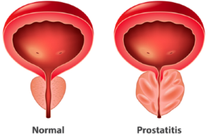Disfunción Eréctil