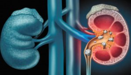 Disfunción Eréctil